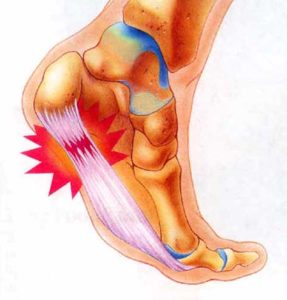 Plantar_Fasciitis1